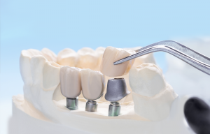 Cuánto dura una corona dental
