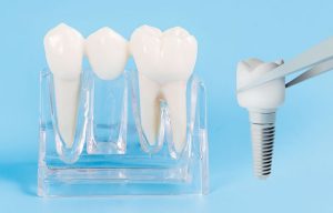 Implante Dental o Puente Dental