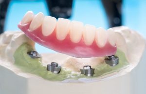 Implante Dental por diente perdido