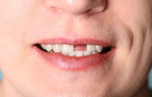 Implante Dental sin cirugía