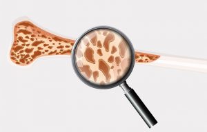 Implantes Dentales con Osteoporosis