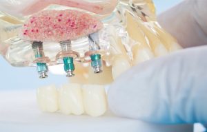 Implantes Dentales cuando no hay hueso
