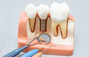 Cuántos Implantes Dentales se ponen en un día
