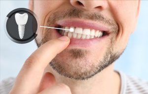 Implantes dentales previenen problemas