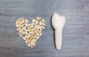 Ventajas de Implantes Dentales