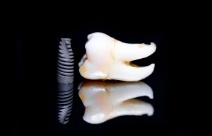 Para qué sirve un implante dental